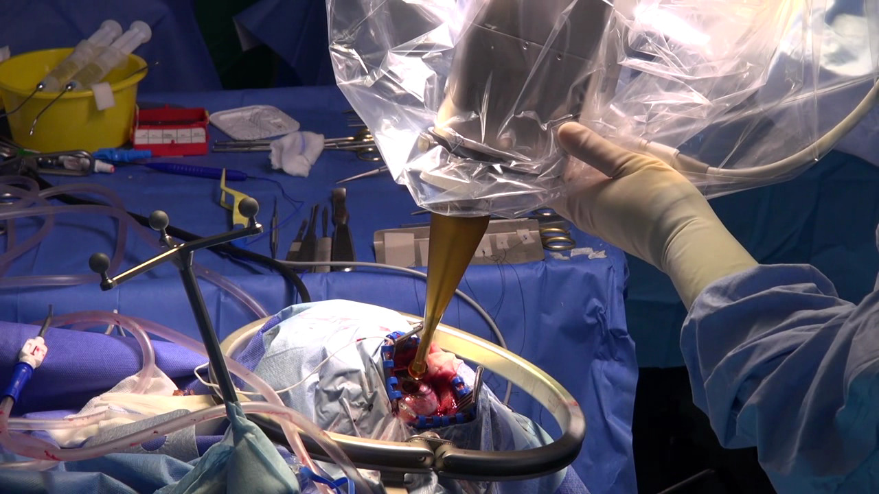 Radioterapia intraoperatória (IORT) durante a ressecção de metástases cerebrais
