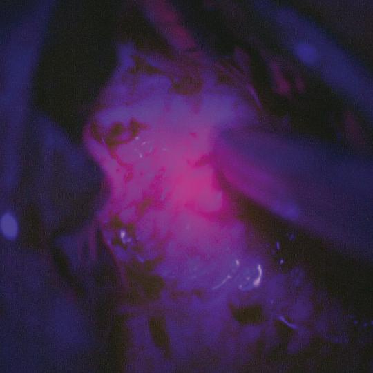 Maximum brain tumor resection