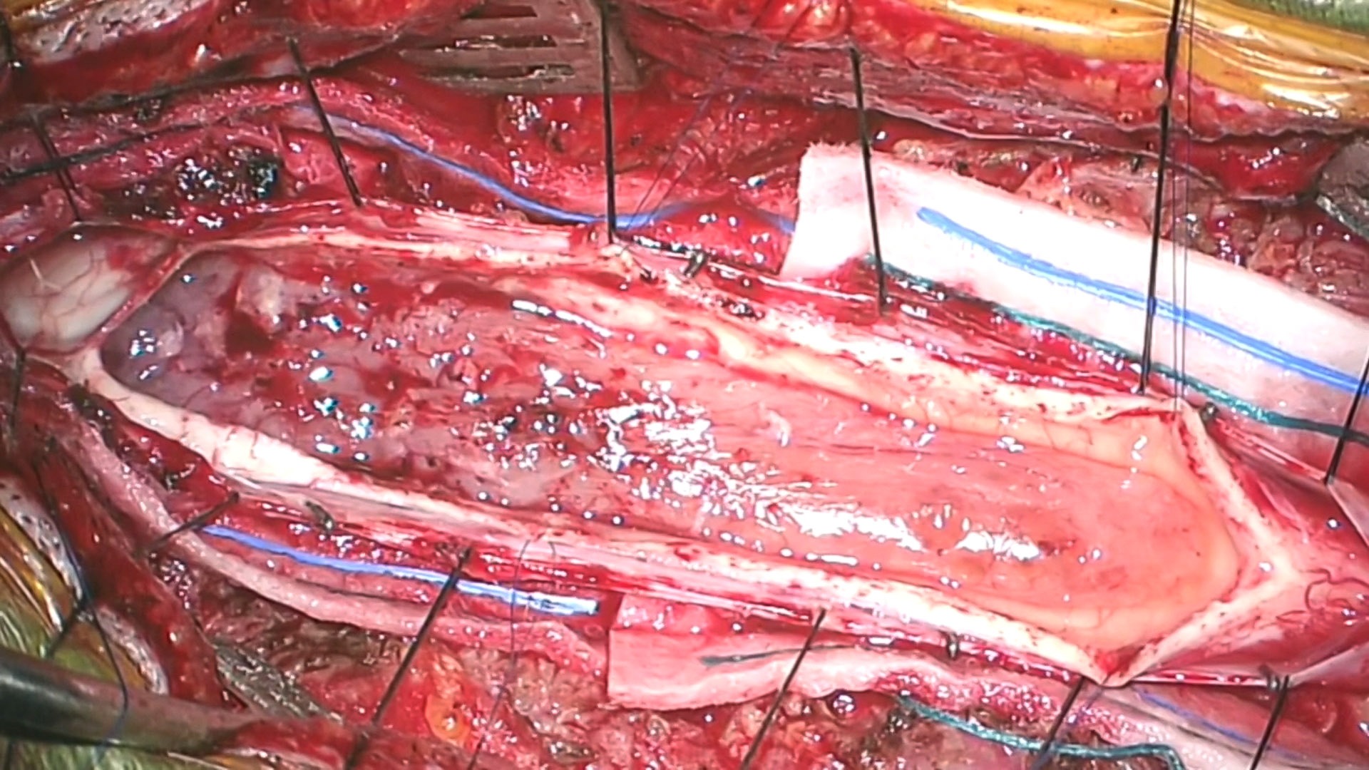 Tratamento cirúrgico de tumores intramedulares da medula espinal