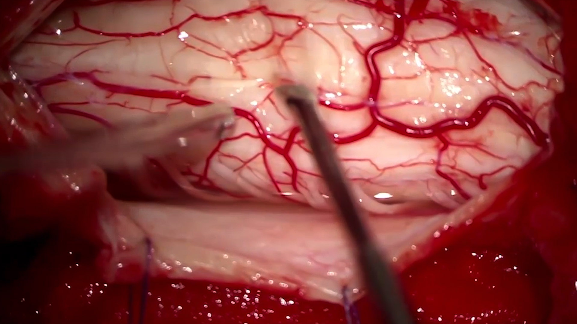 Incisão da medula espinal