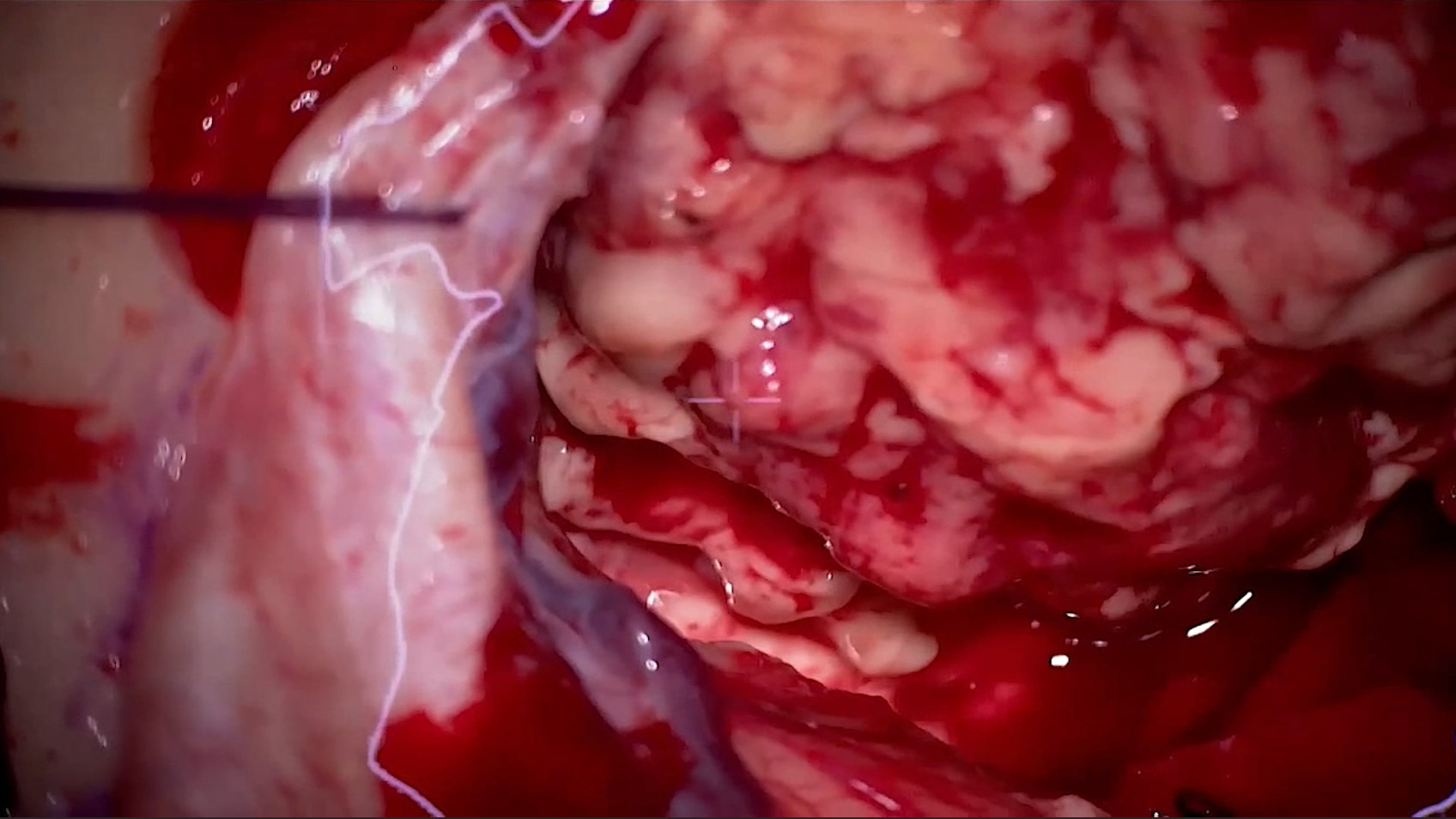 Maximum brain tumor resection