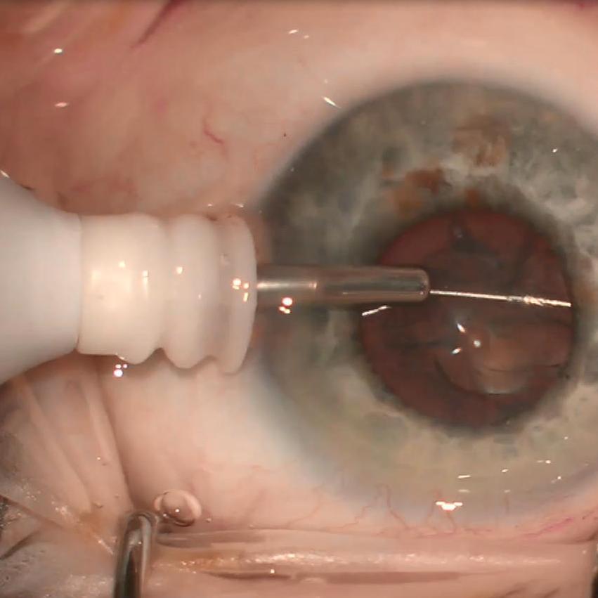 Fragmentation du cristallin d'une cataracte à l'aide de ZEISS miLOOP ; image reproduite avec l'aimable autorisation du Dr Florian Kretz, DEU