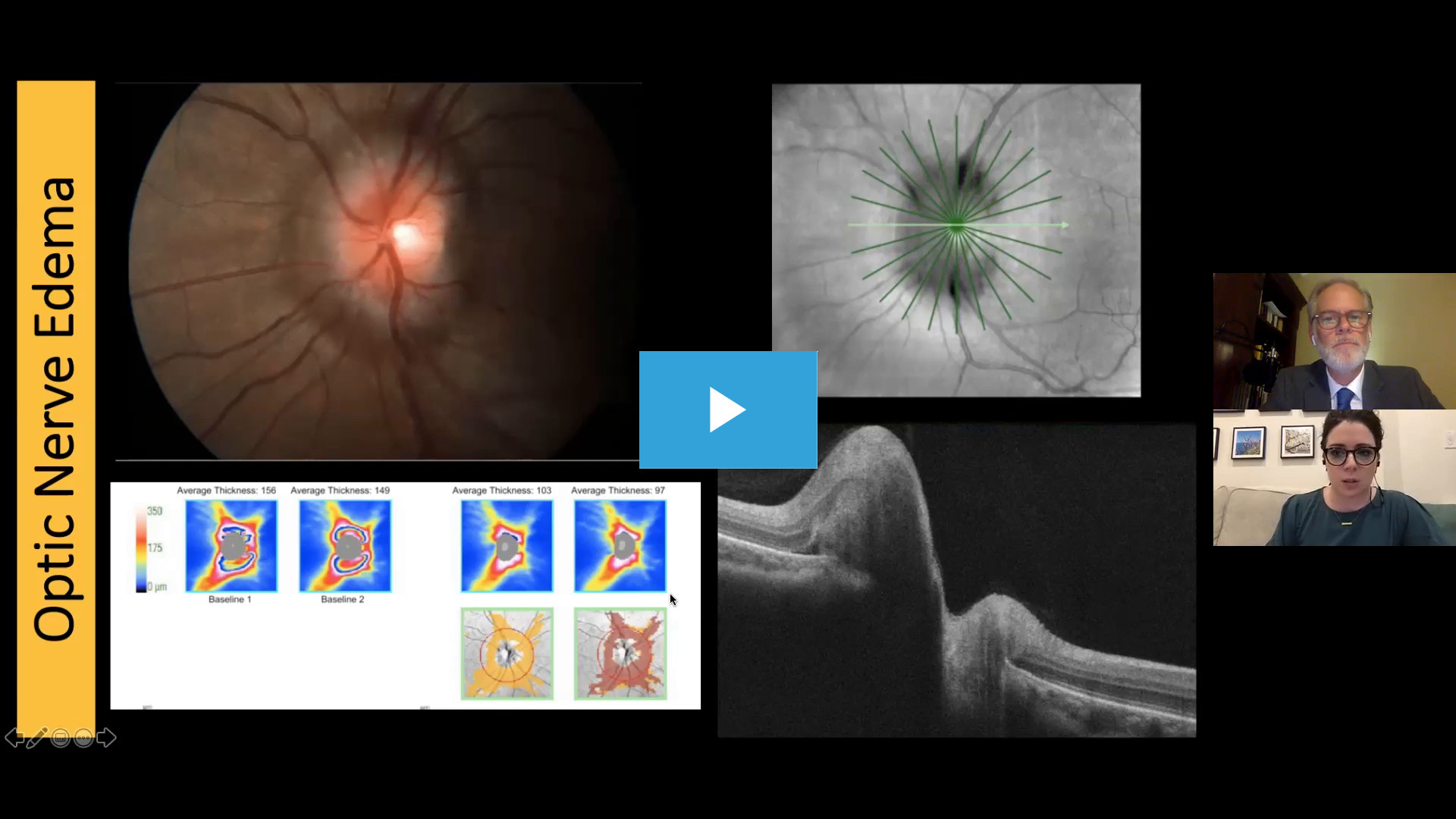 OCT Interpretation From Anterior to Posterior