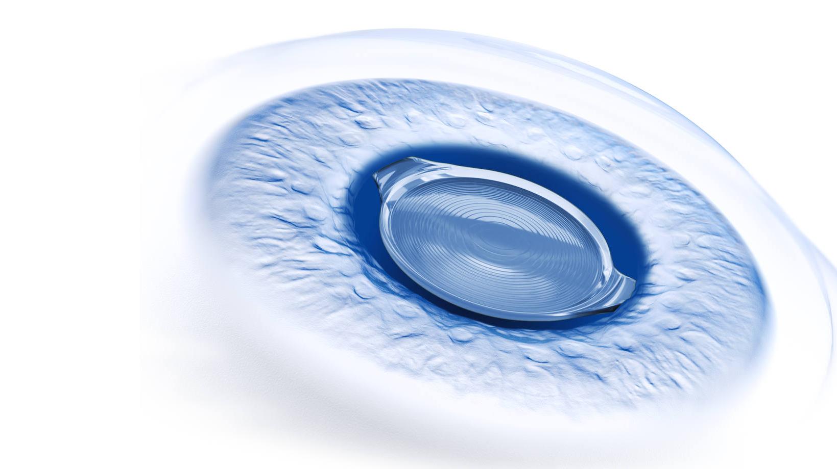 ZEISS Premium Cataract Workflow