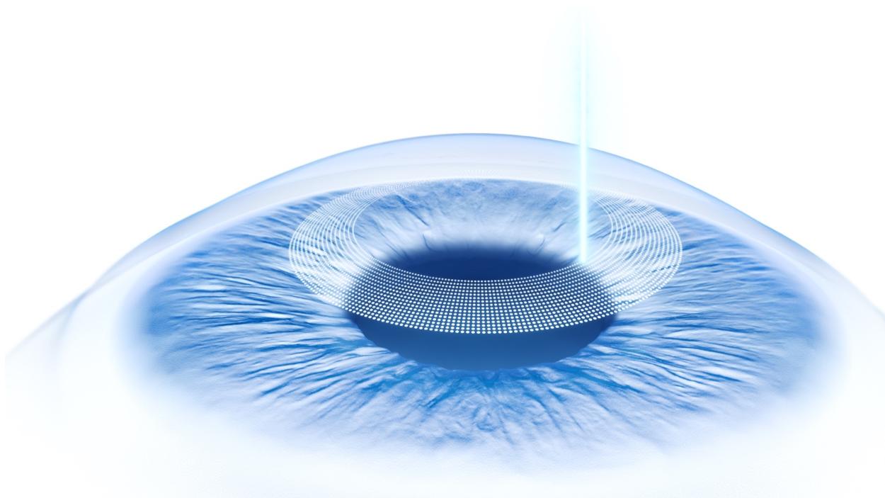ZEISS Corneal Refractive Workflow