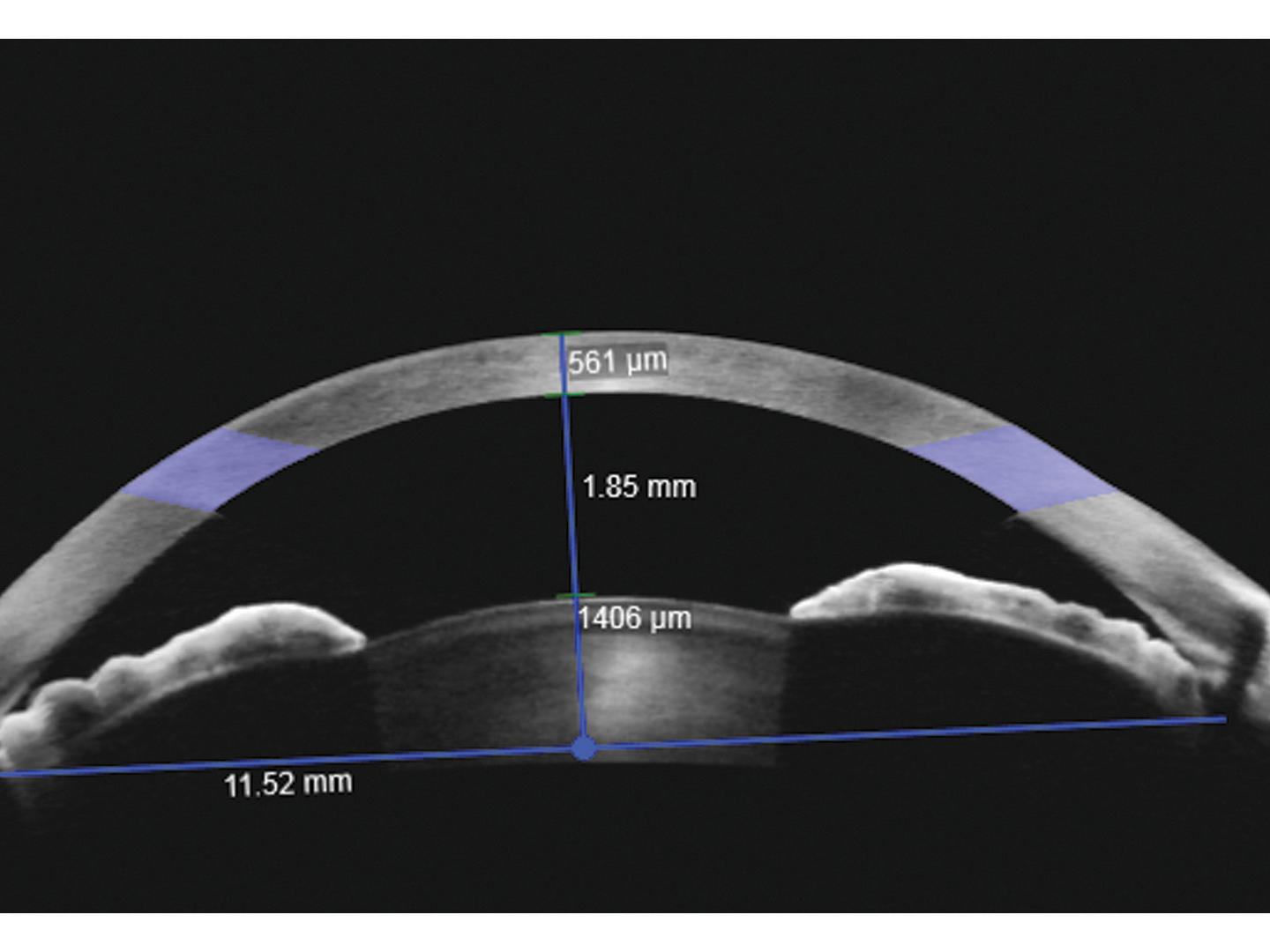 Cross-sectional image of a human eye showing corneal thickness, anterior chamber depth, and other measured dimensions marked with blue lines and numerical values.