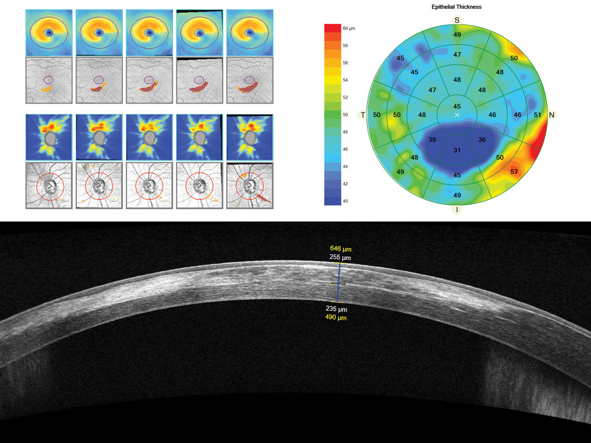 Image showing corneal epithelial thickness maps, topographical heat maps, and a cross-sectional OCT scan of the eye with precise thickness measurements.