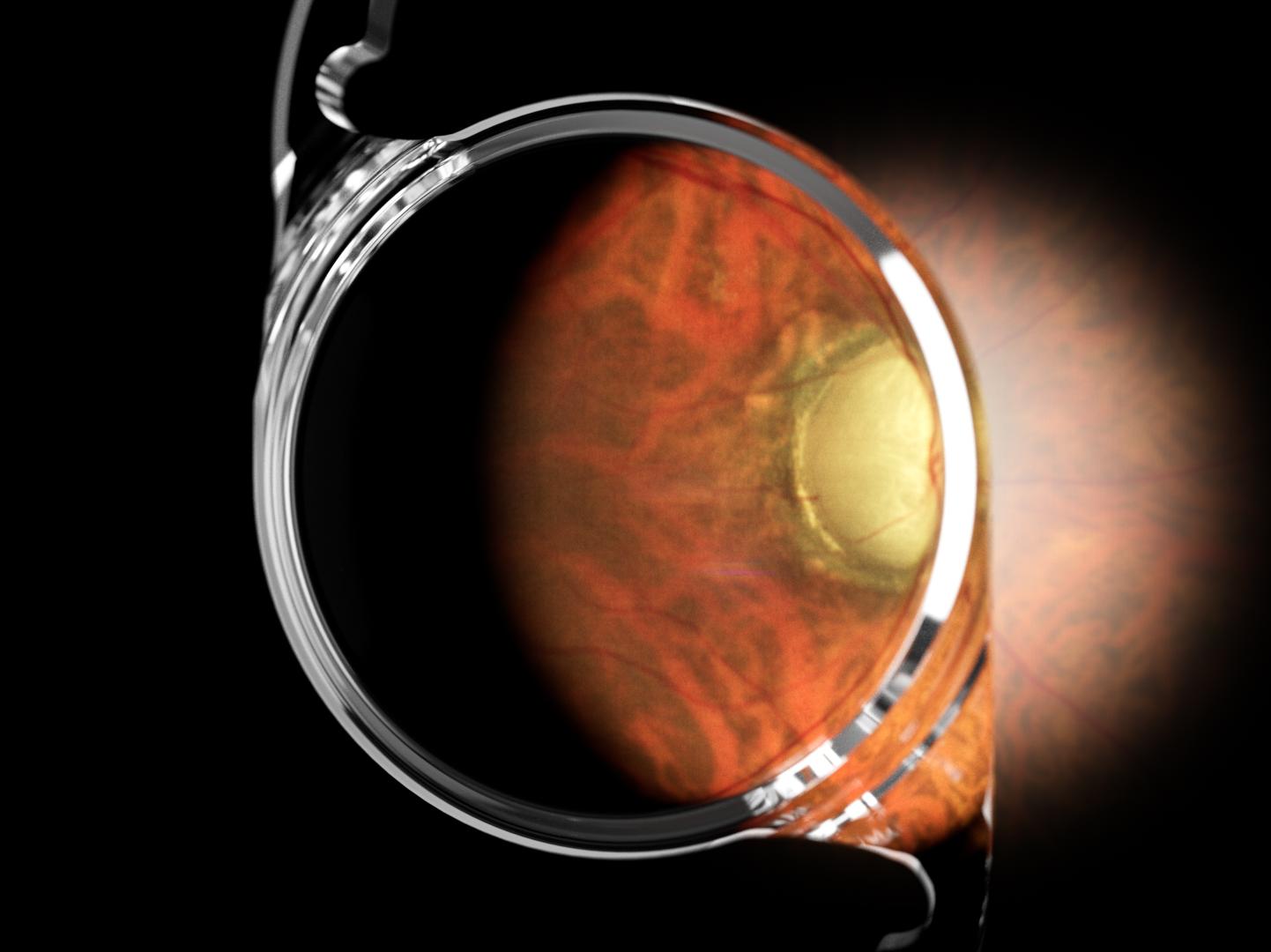 Cataract with glaucoma