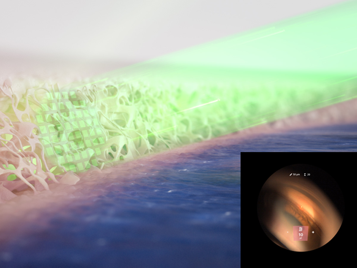 Visualization of a high-resolution laser beam interacting with tissue or material structure, with an inset showing a magnified view through a medical imaging device.