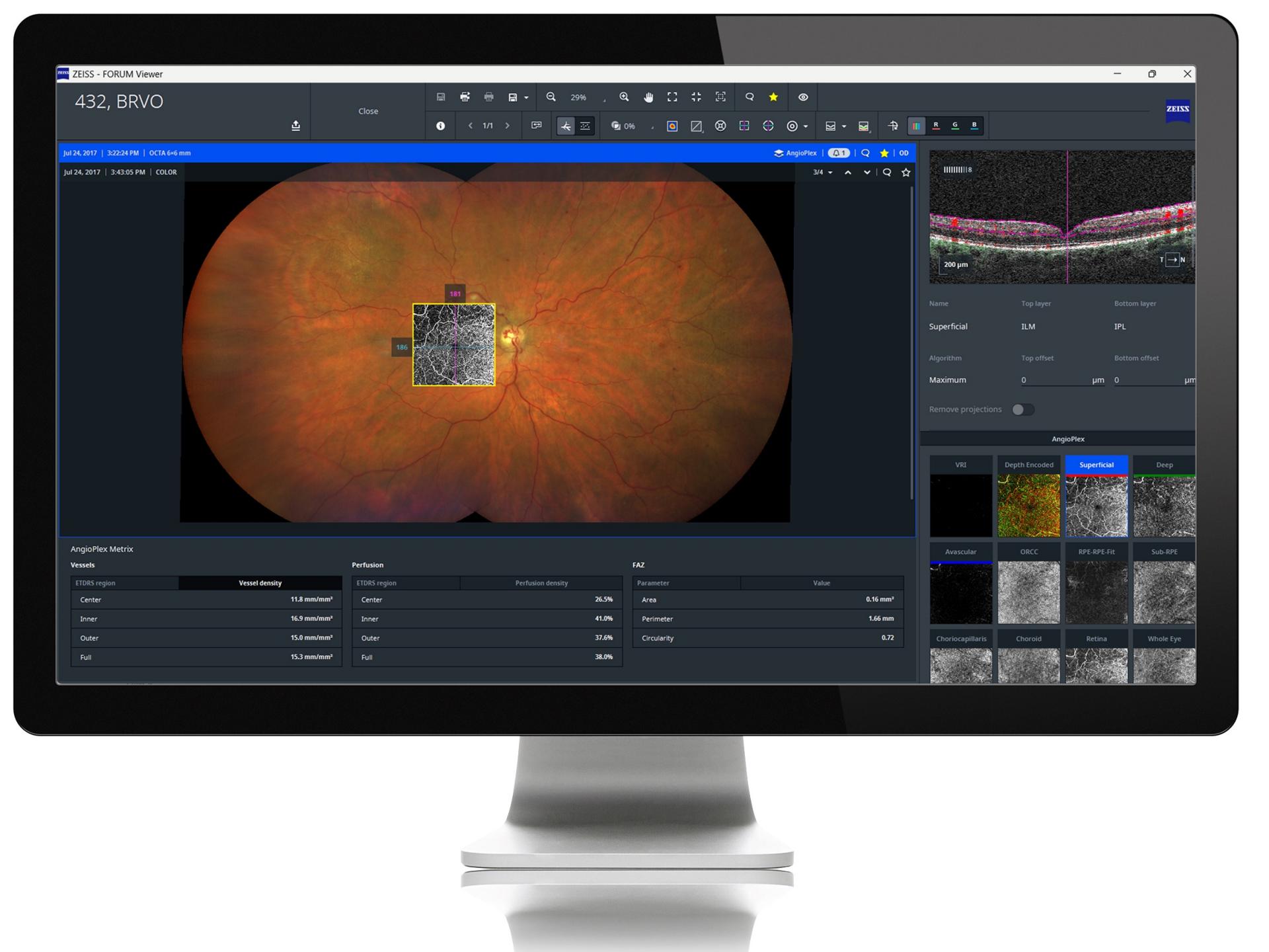 Computer monitor displaying ZEISS medical imaging software with a detailed retinal scan and various diagnostic views.