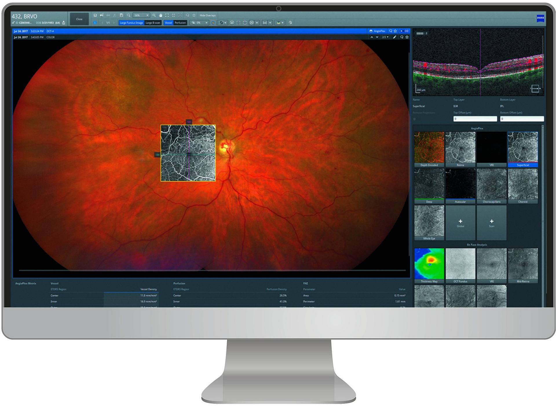 Computer monitor displaying ZEISS medical imaging software with a detailed retinal scan and various diagnostic views.