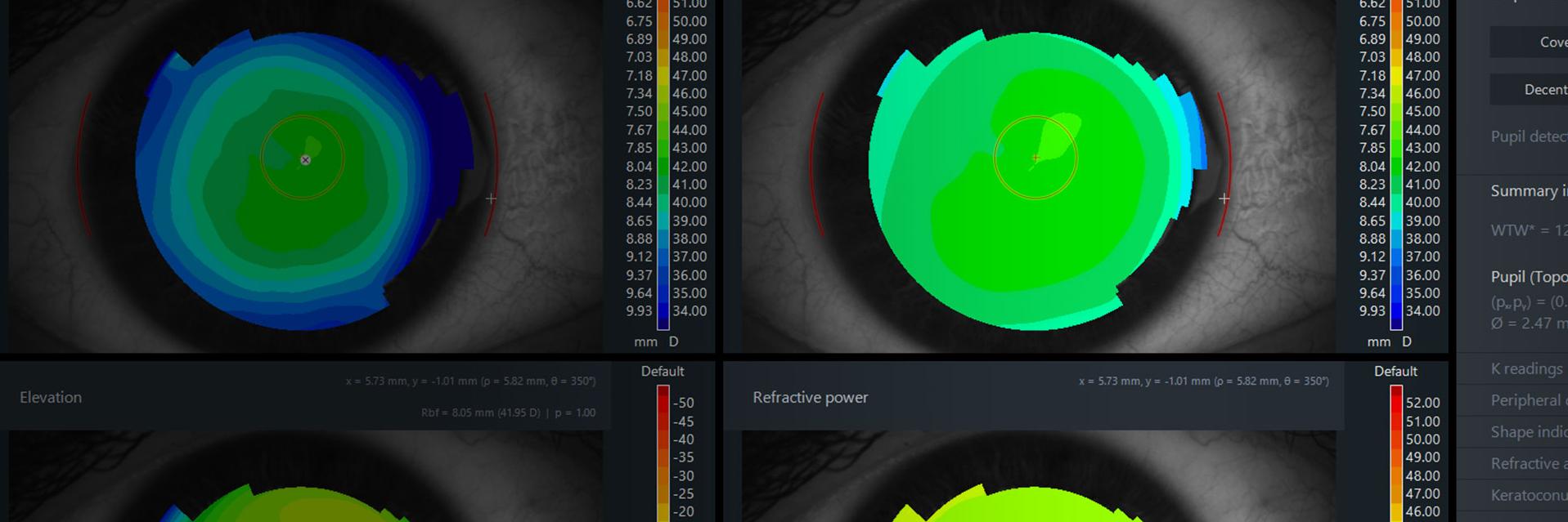 Image of ZEISS ATLAS 500: Presbyopia Management