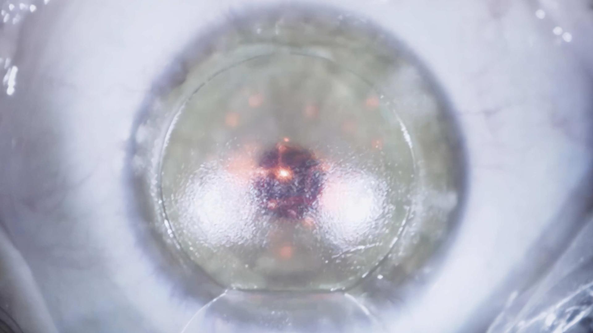 Imagem de um olho do Tratamento de presbiopia ZEISS: Tratamento