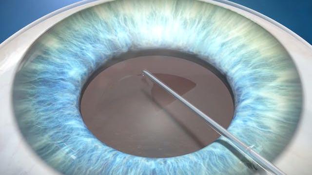 Opening of the capsular bag during cataract surgery.
