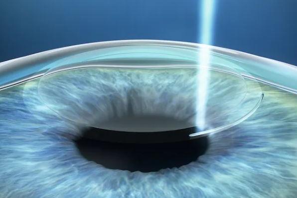 A Laser creates a small opening in the eye lens.