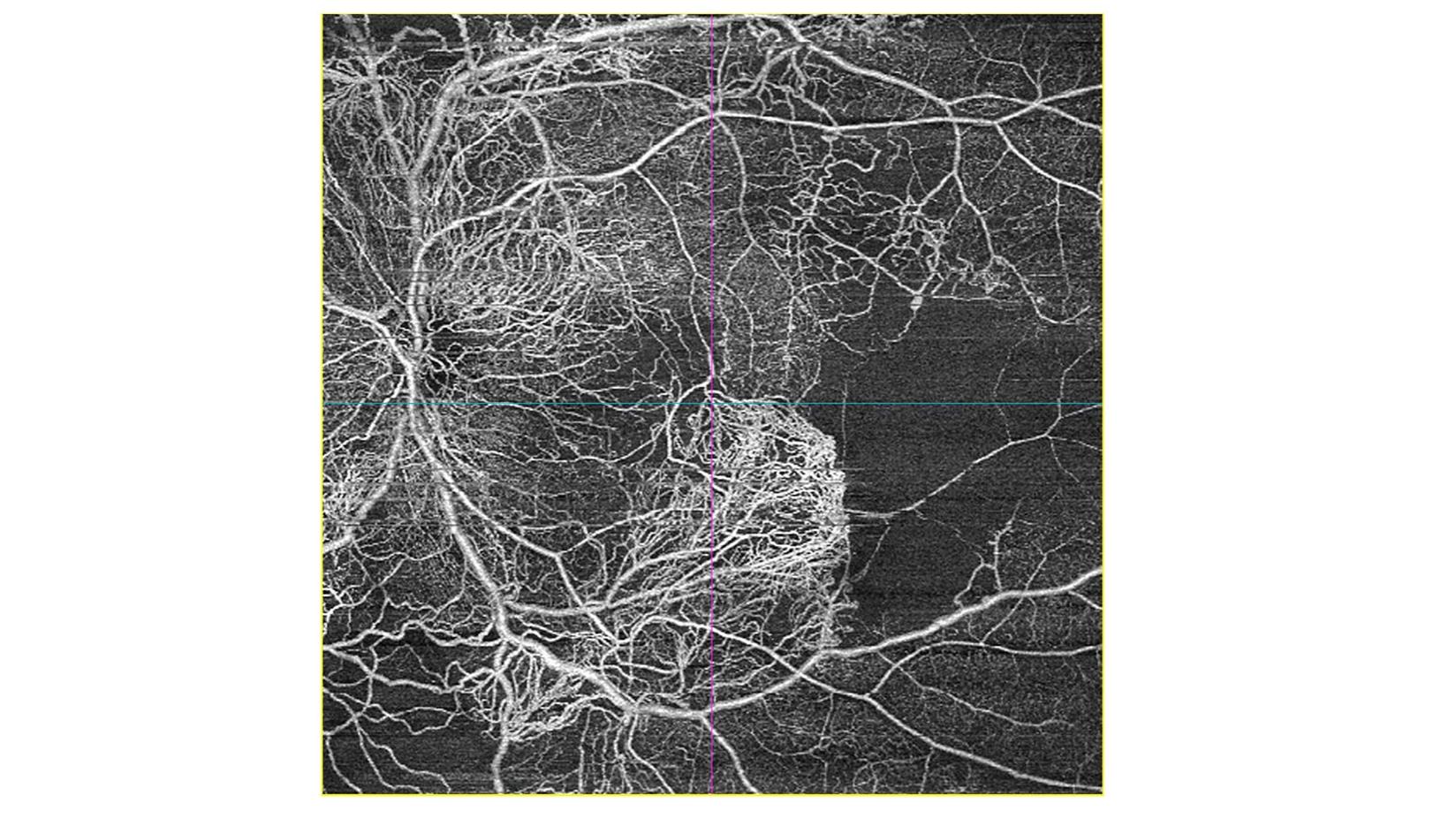 OCT Angiographie