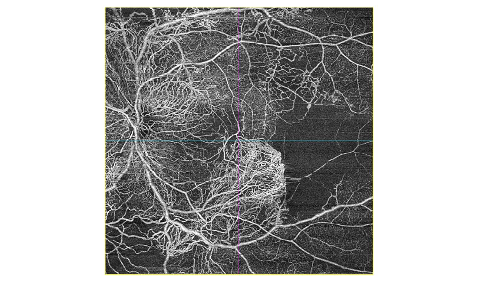 OCT Angiography