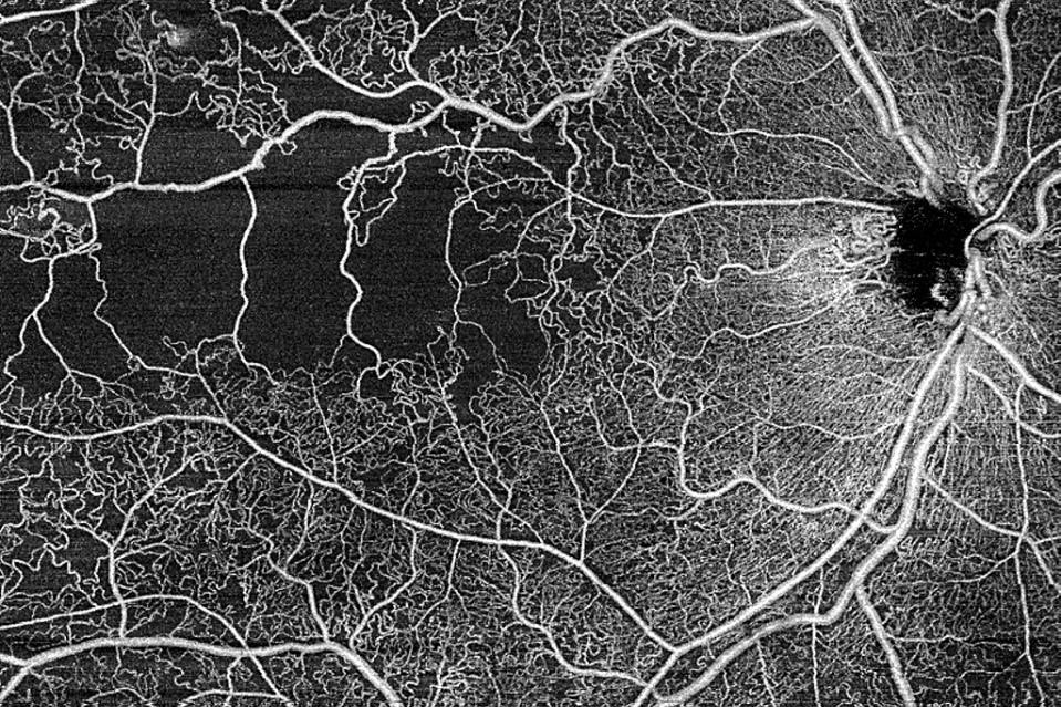 ZEISS PLEX Elite