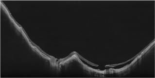 Vorschaubild von Ultra-HD-Spot eines myopischen Staphyloms 