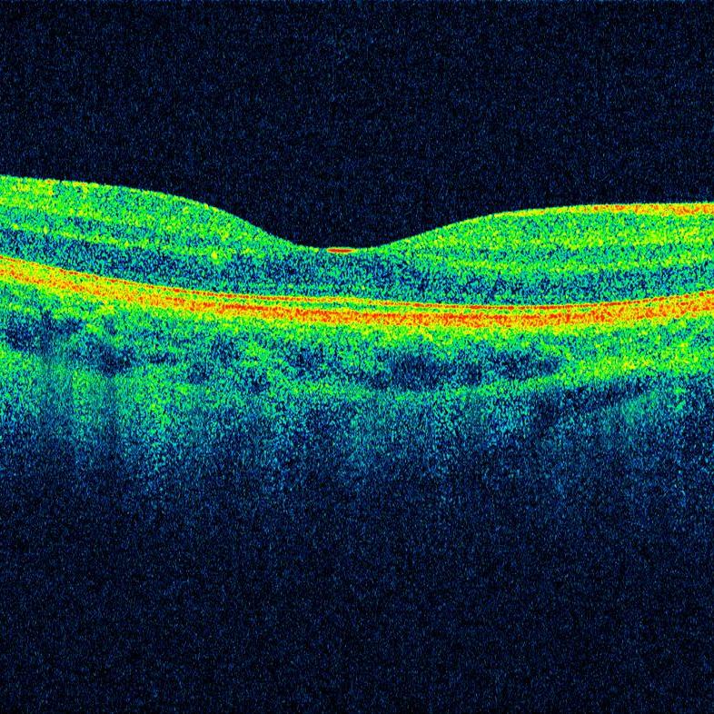 OCT retina scan