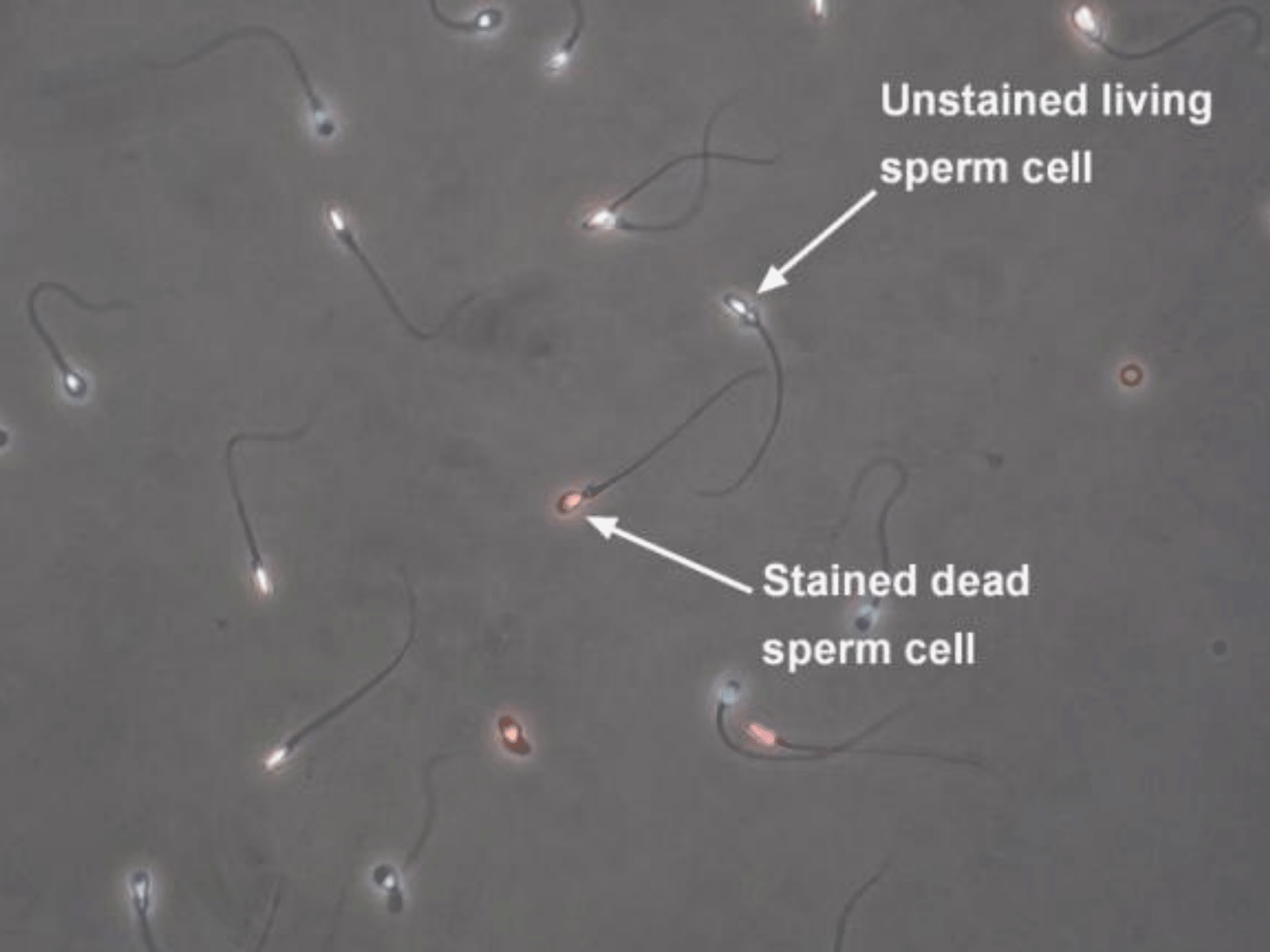 Immobile Sperm Eosine Y Vitalaity Test