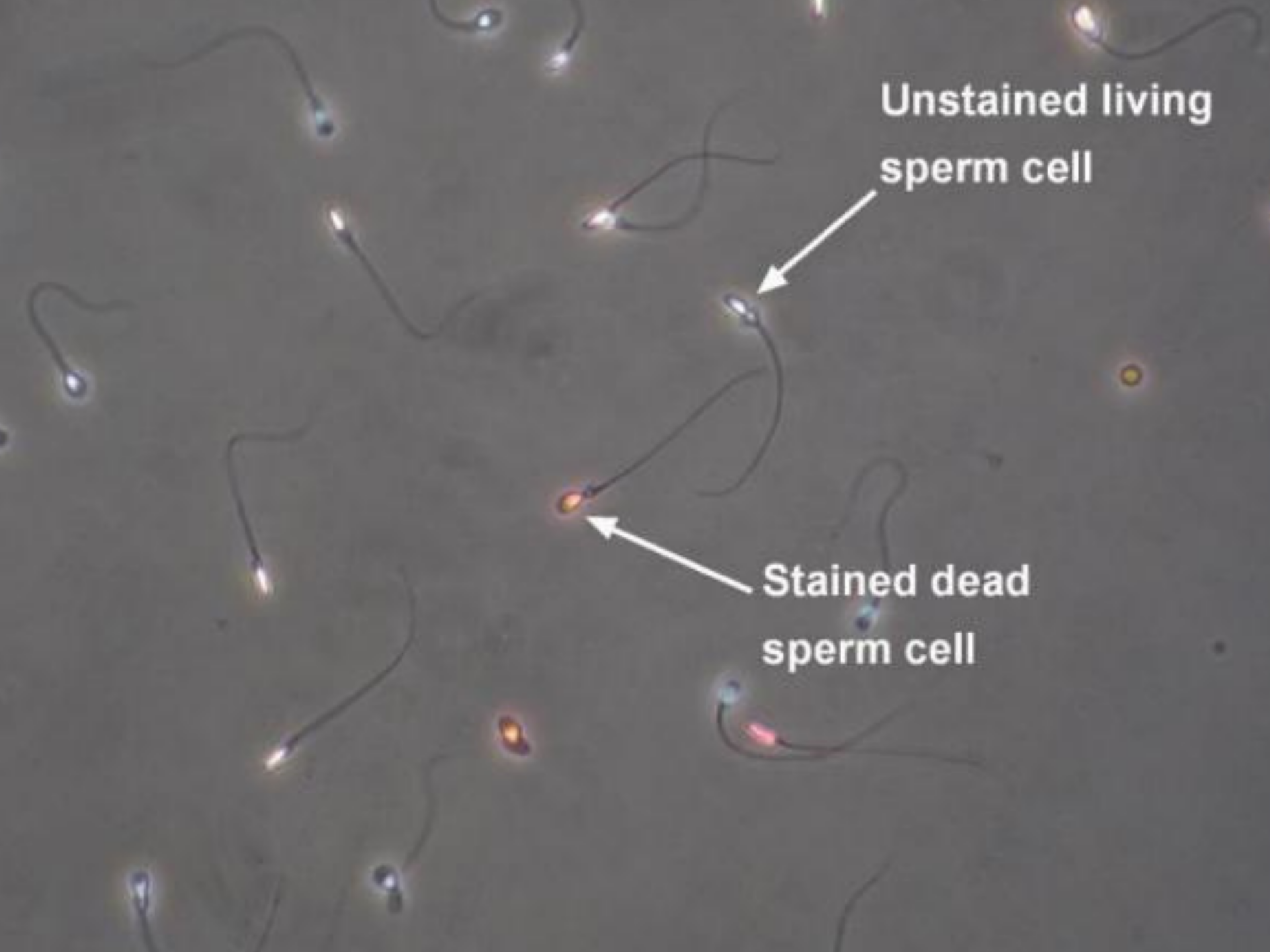 Immobile Sperm Eosine Y Vitalaity Test