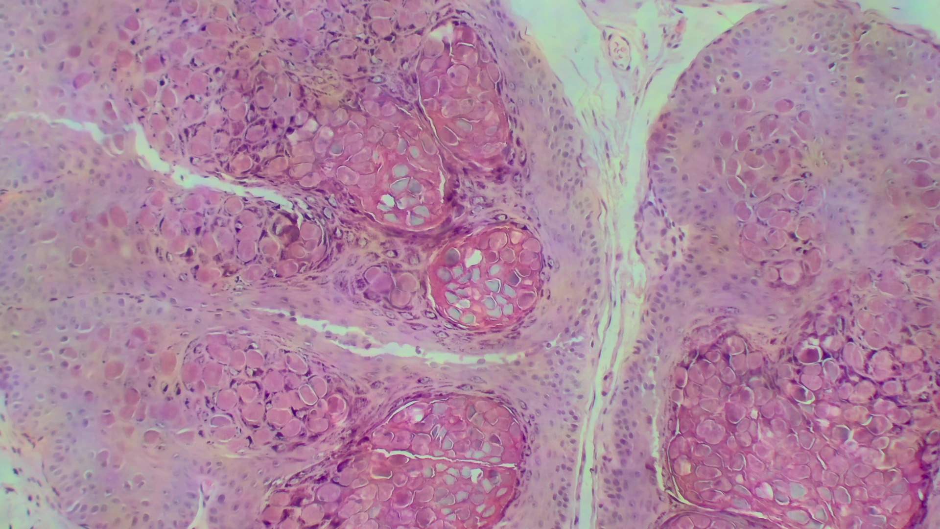 Molluscum Contagiosum; the focus is on the molluscum bodies, which affect the cell leaving it ballonated and purplish. It is a virus (pox virus) common in children and adults in the genital area, Primostar 3, 10x objective, Axiocam 208 color,
