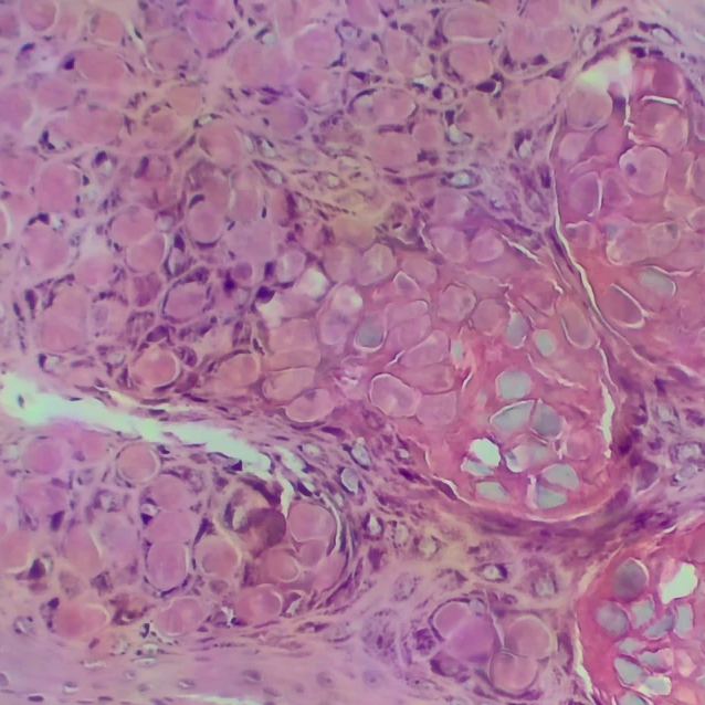 Molluscum Contagiosum; the focus is on the molluscum bodies, which affect the cell leaving it ballonated and purplish. It is a virus (pox virus) common in children and adults in the genital area, Primostar 3, 10x objective, Axiocam 208 color,