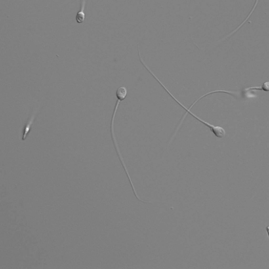 In Vitro Fertilization