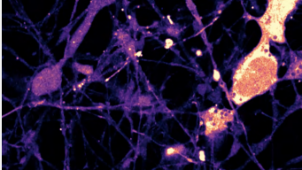 Neuronal activity in brain cells generated from a patient with a genetic neurodevelopmental disorde