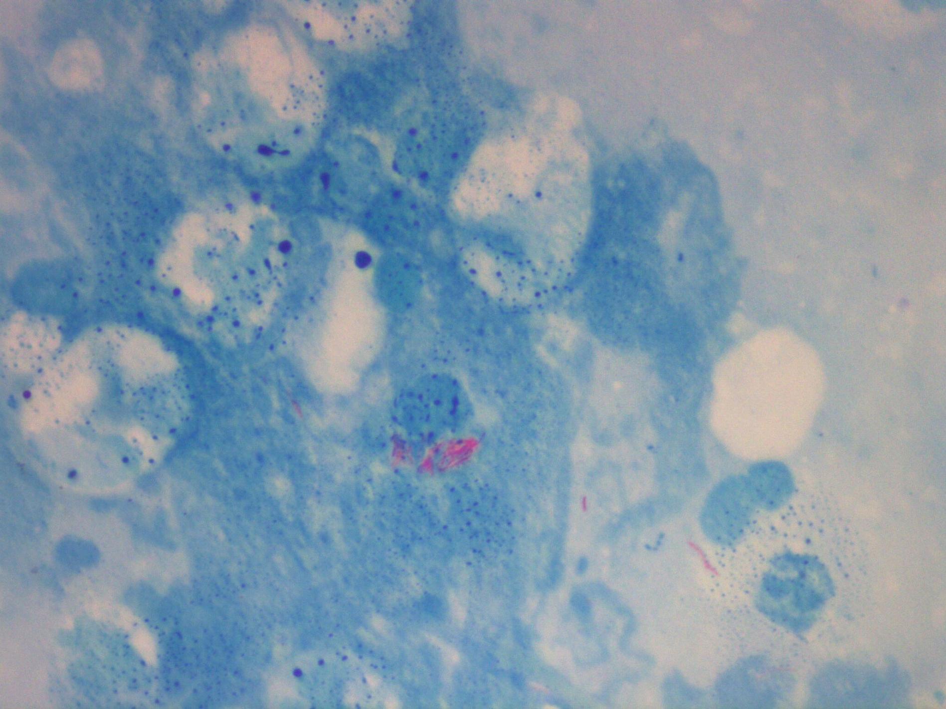 Microscopic view of Ziehl-Neelsen (Acid-Fast) Staining
