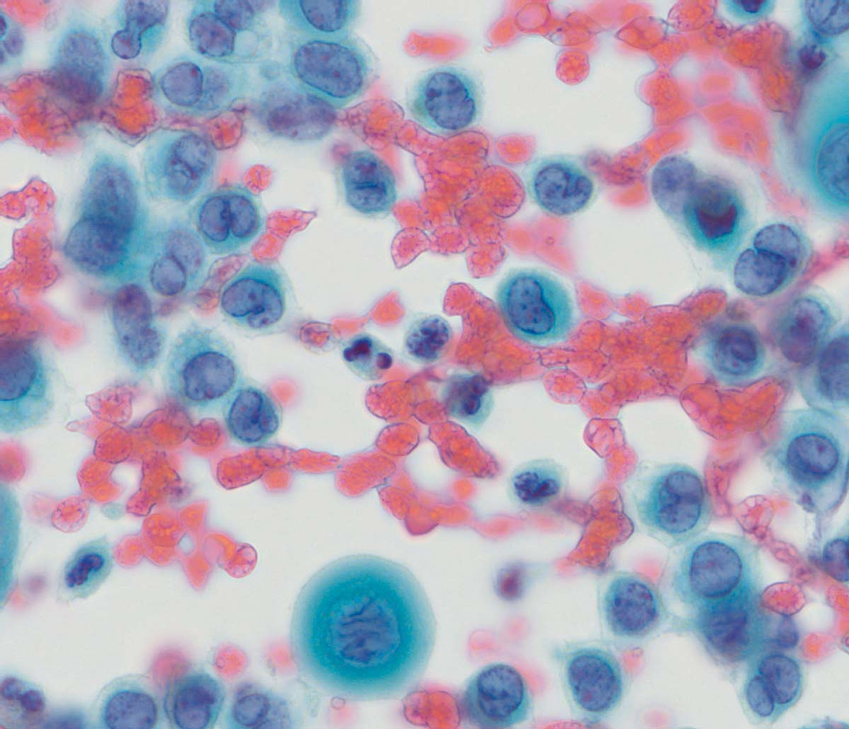 Microscopic view of Papanicolaou (Pap) Stain