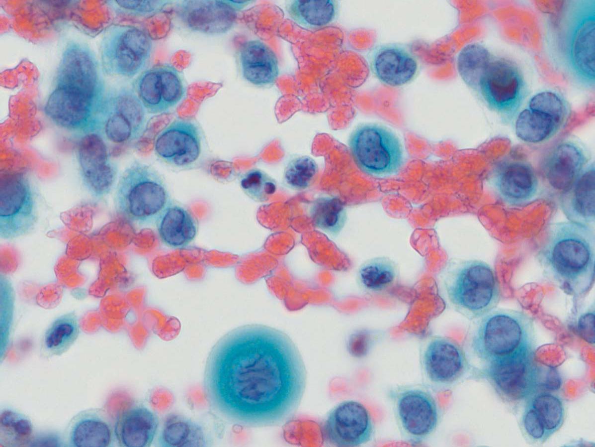 Microscopic view of Papanicolaou (Pap) Stain