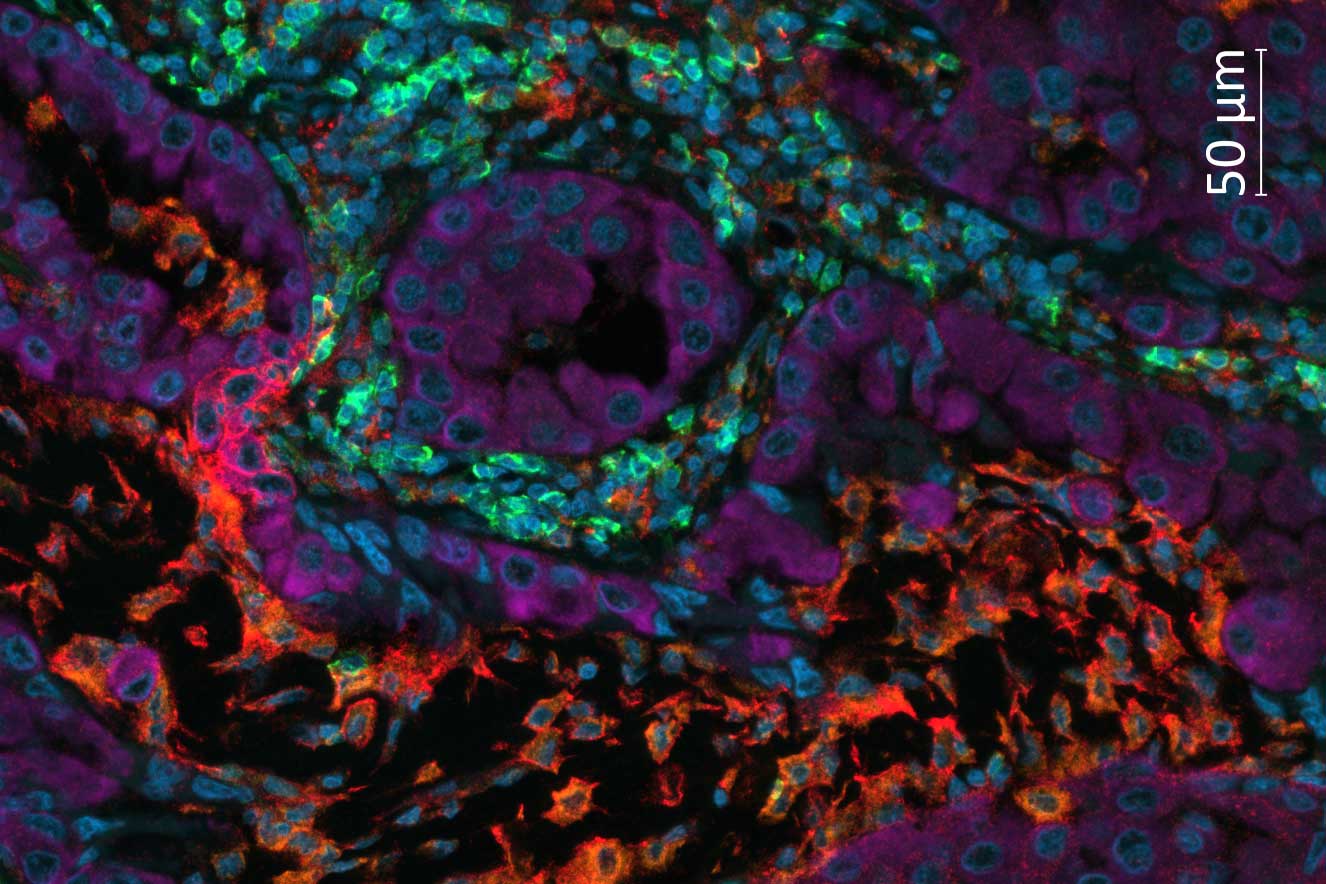 Multiplex-Imaging von Gewebe eines nicht-kleinzelligen Bronchialkarzinoms (NSCLC), gefärbt mit UltiMapper I/O PD-L1 Kit.