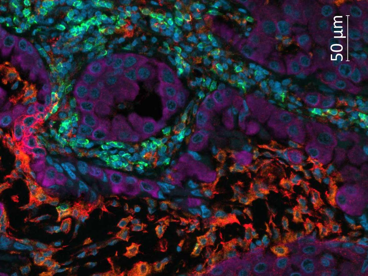 Multiplex imaging of non-small cell lung cancer (NSCLC) tissue stained with UltiMapper I/O PD-L1 kit.