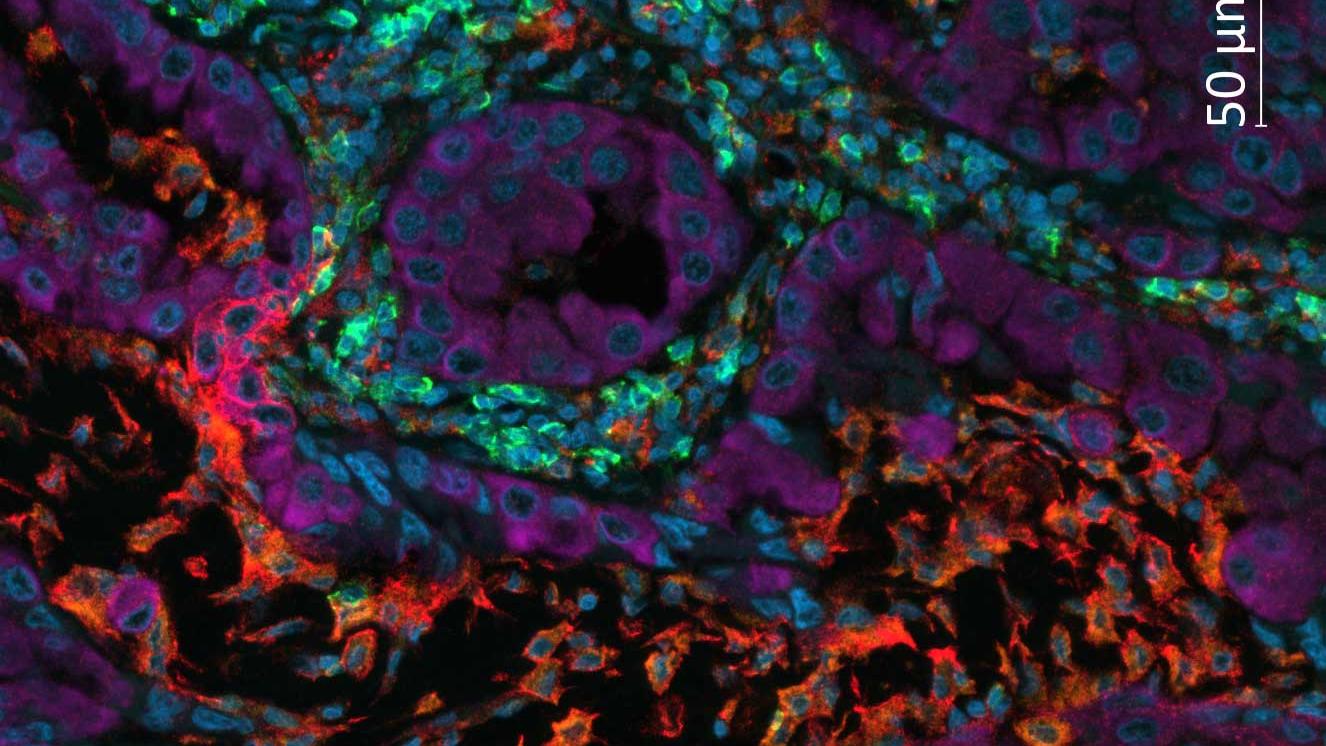 Non-small cell lung cancer (NSCLC) tissue stained with UltiMapper I/O PD-L1 kit. Nuclear counterstain (blue), CD8 (green), CD68 (orange), PD-L1 (red), panCytoKeratin (magenta). 