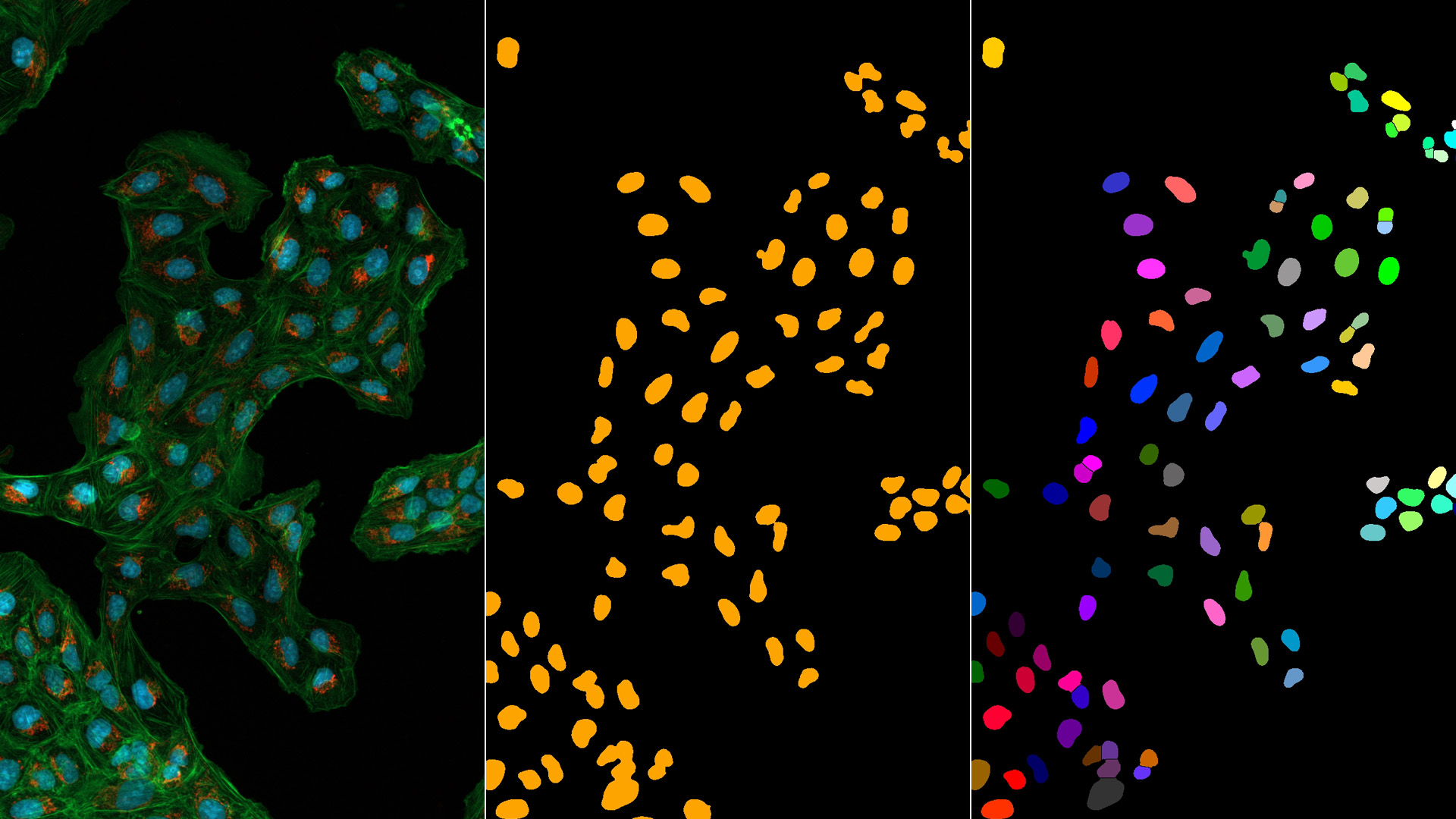 Osteosarcoma cells