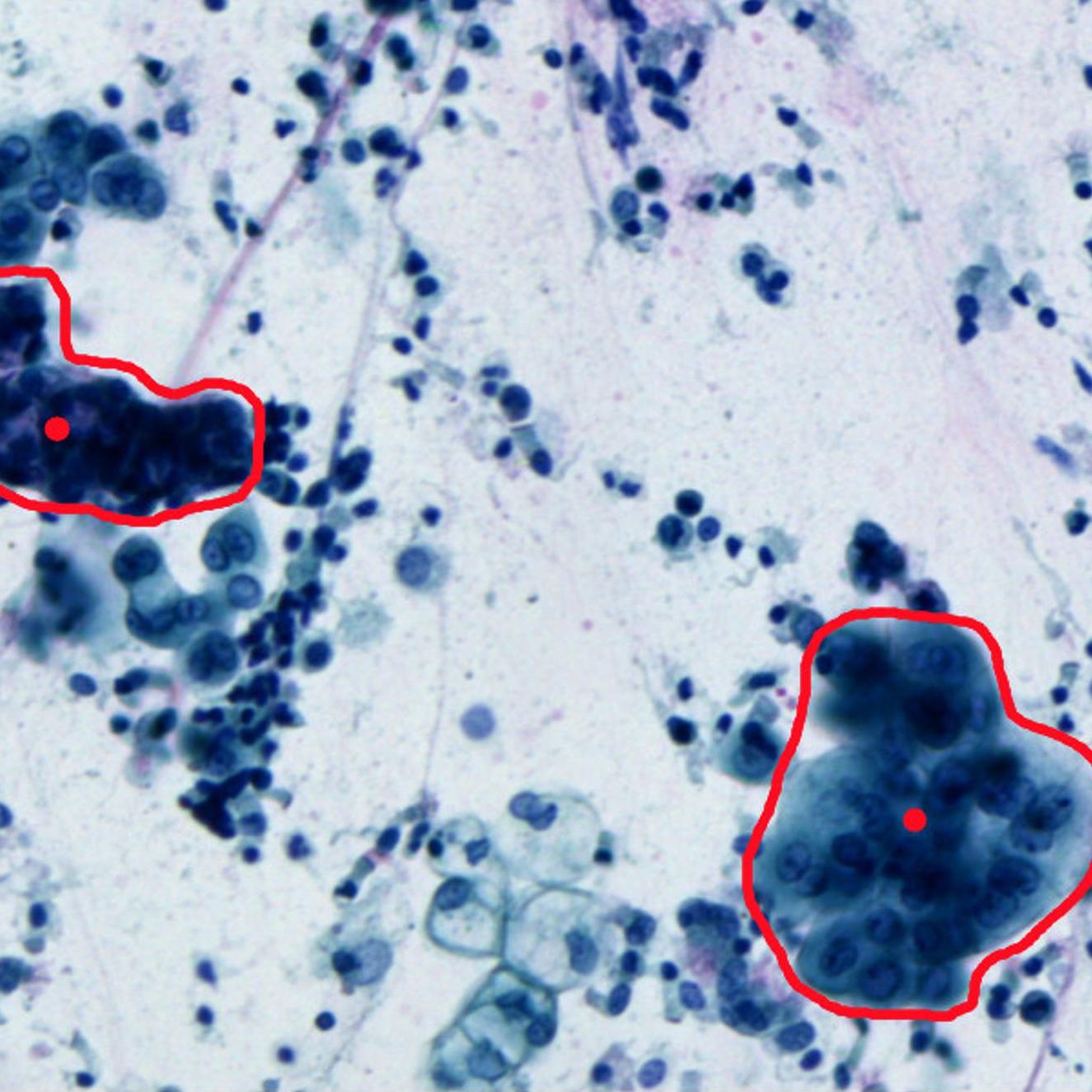 Isolating tumor cells in lung tissue