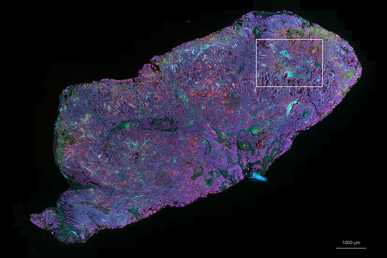 Gewebeschnitt eines nicht-kleinzelligen Bronchialkarzinoms (NSCLC), abgebildet mit einem digitalen Slide-Scanner. Fluoreszenzfärbung mit UltiMapper I/O PD-L1 Kit. Probe mit freundlicher Genehmigung von Ultivue, Inc., USA *