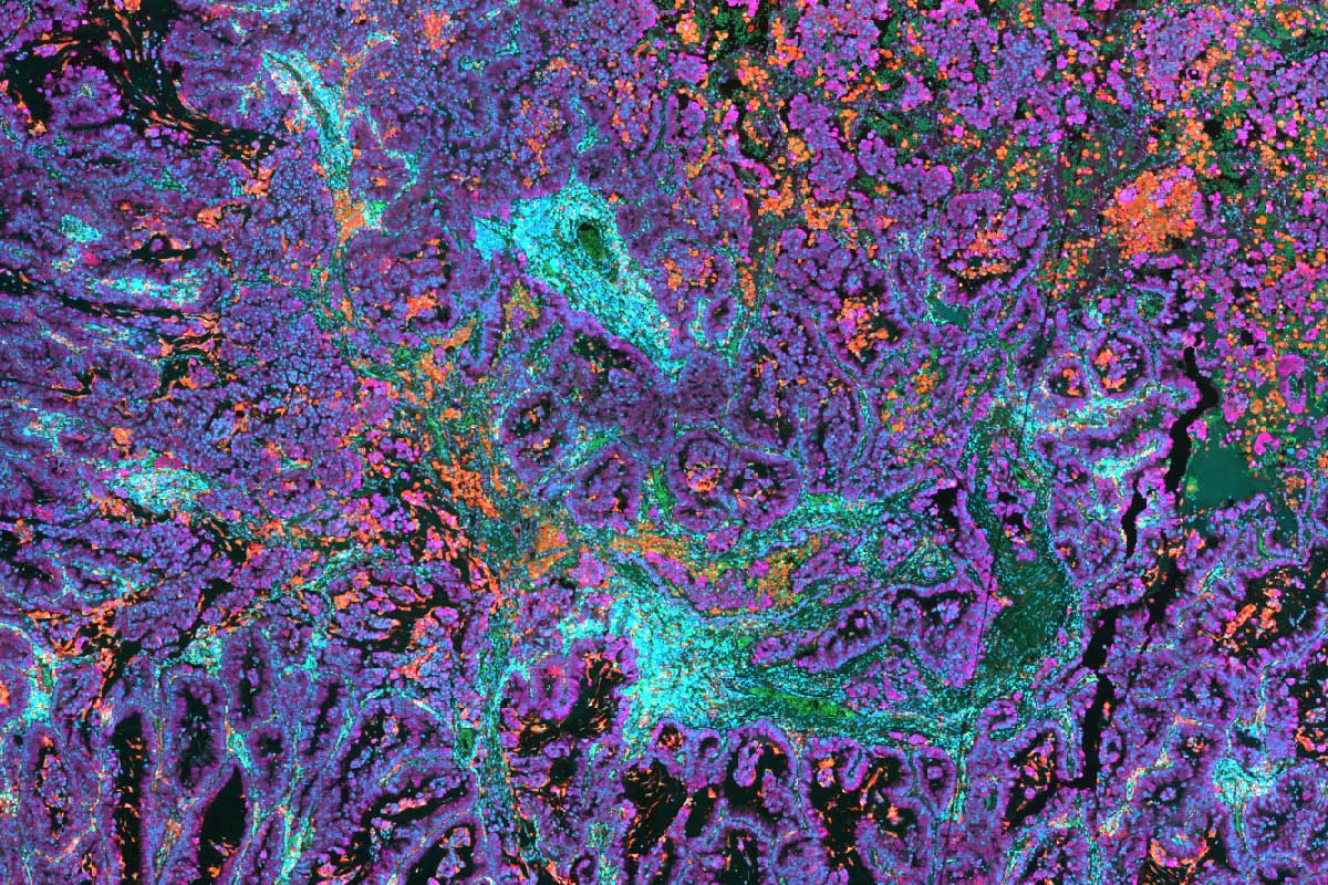 Sección de tejido de cáncer de pulmón de células no pequeñas (NSCLC), detalle de imagen Enmarcado en la imagen (en la parte izquierda)
