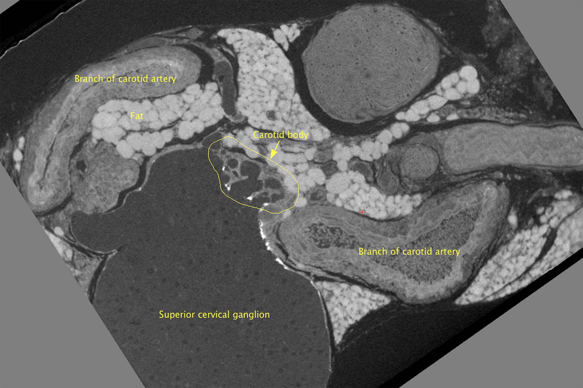 Coupe 2D à partir d'une reconstruction 3D d'un échantillon préparé pour la microscopie électronique à balayage en série (SBF-SEM). L'image au microscope à rayons X capturée avec ZEISS Xradia Versa a été utilisée pour la coupe ultérieure de l'échantillon et l'acquisition ciblée à l'aide de la microscopie électronique volumétrique. 