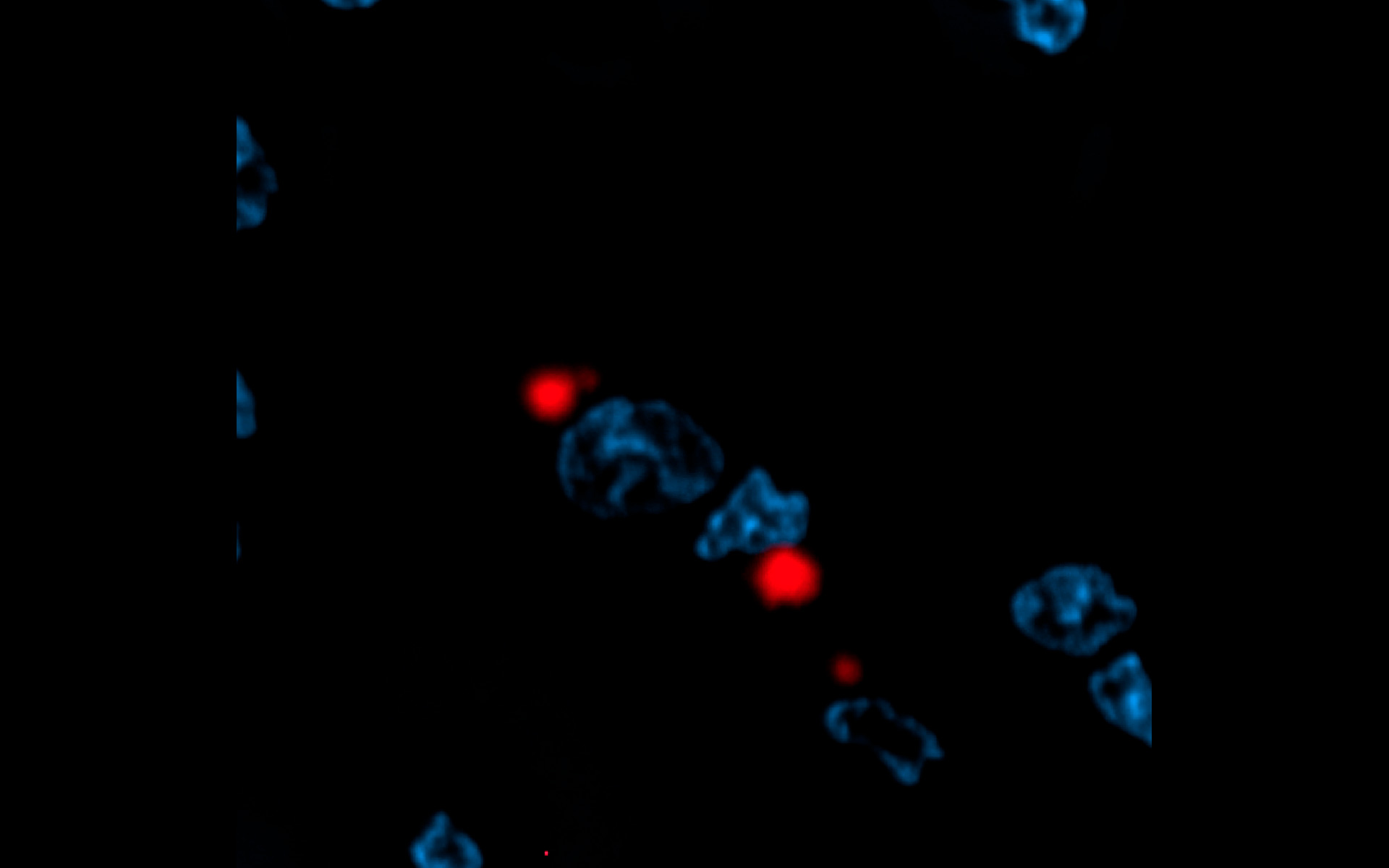 Makrophagen mit Proteinplaques, induziert durch Aggregation des mutierten Huntingtin-Proteins
