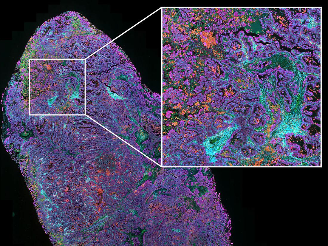 Non-small-cell lung cancer tissue (NSCLC) in fluorescence contrast, nuclear counterstain (blue), CD8 (green), CD68 (orange), PD-L1 (red), panCytoKeratin (magenta)