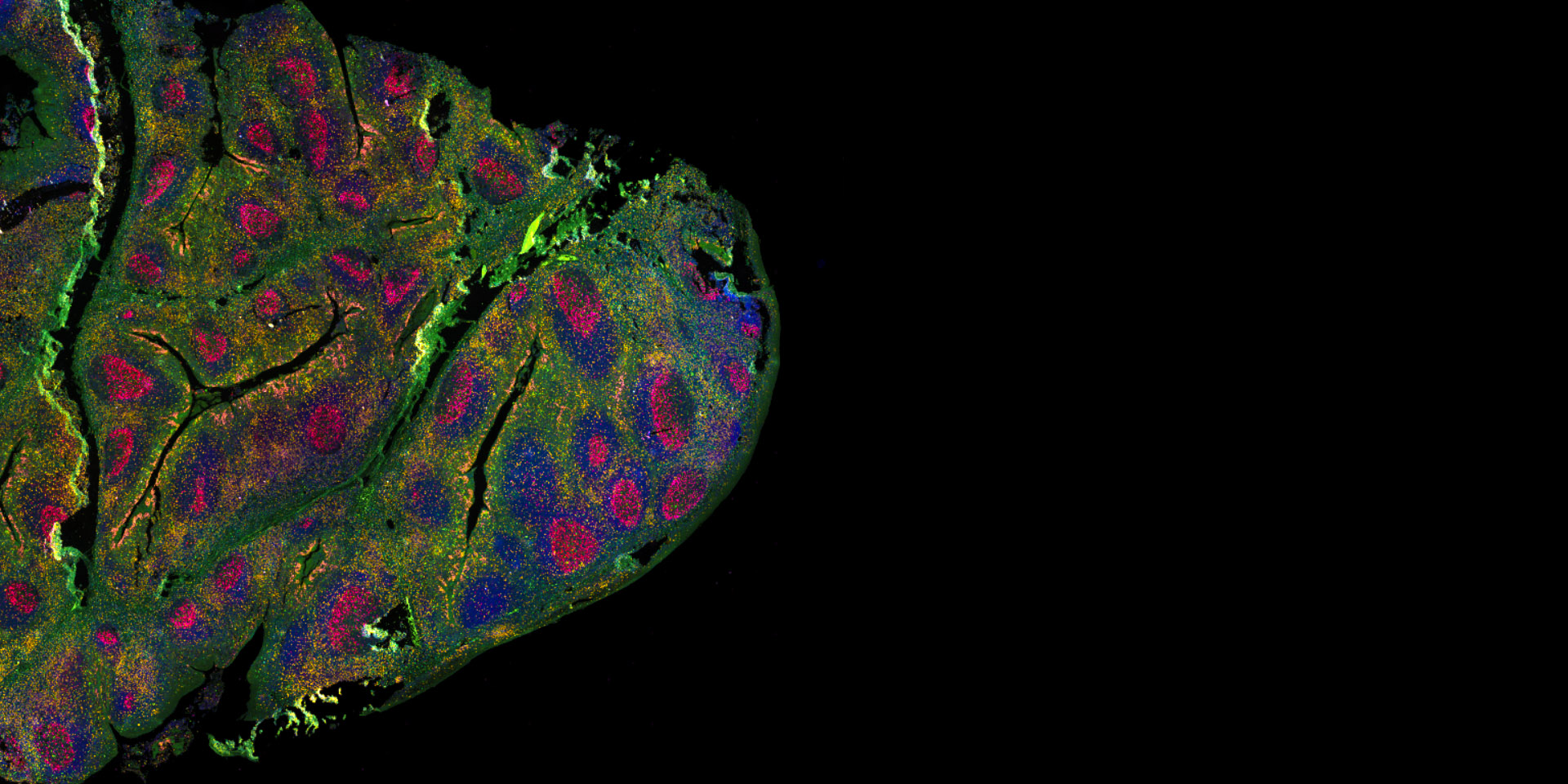 Human tonsil tissue stained with multiple cancer markers