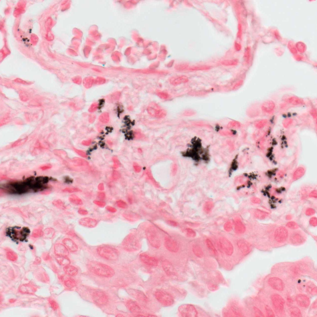 Menschliches Lungenkrebsgewebe. Probe mit freundlicher Genehmigung von: A. Feuchtinger, Helmholtz Zentrum München, Deutschland