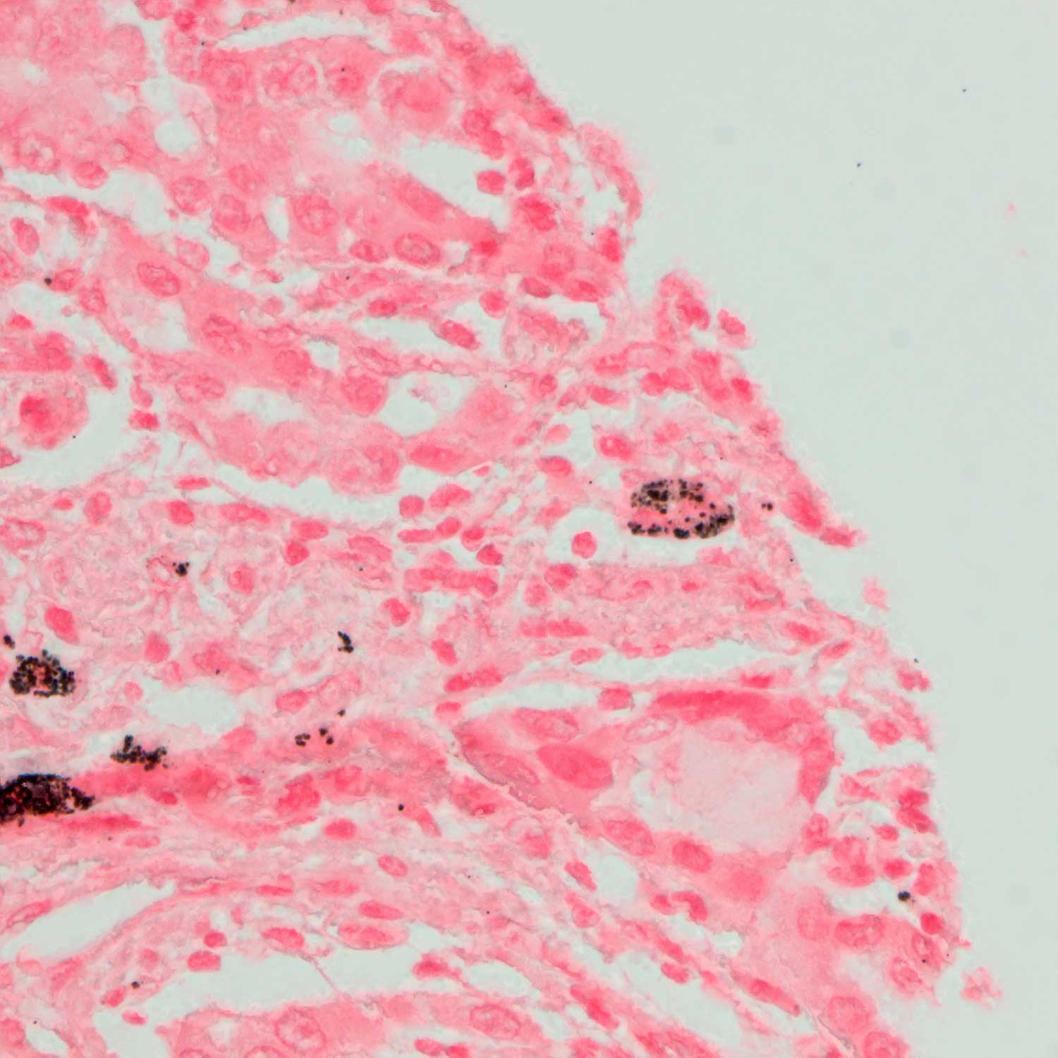 Human cancer tissue