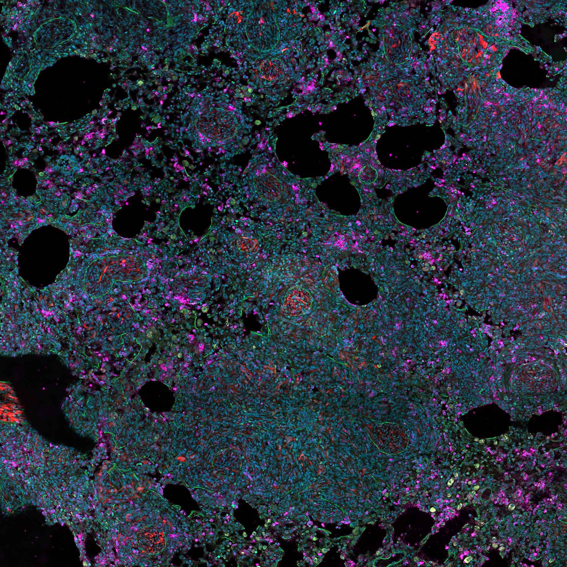 Murine lung tissue with tumor metastasis