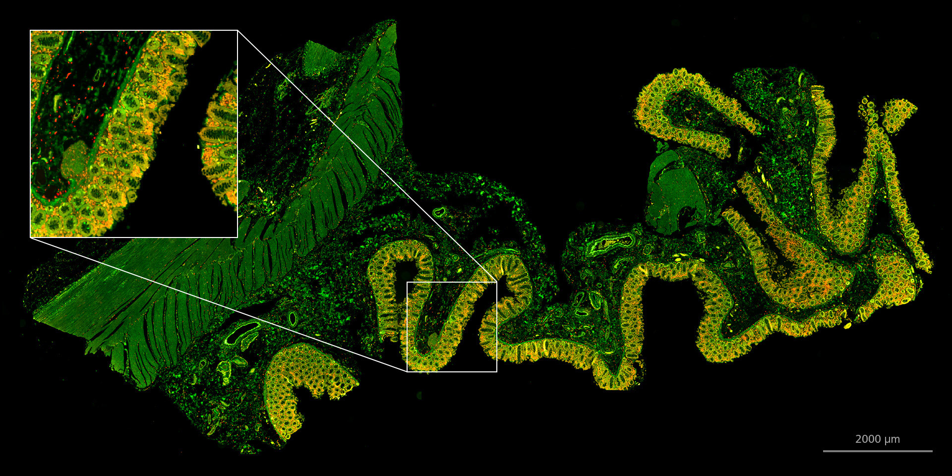 Échantillon du colon d'un patient atteint de la maladie de Crohn, saisie à l'objectif 20× NA 0,8. Vert : Cox-1 dans des cellules en touffe de l'épithélium (cellules sensorielles de l'intestin) et cellules dans le tissu conjonctif lamina propria. Rouge : CD 163 (marqueur de macrophage). Cette image représente le contenu de recherches. ZEISS exclut expressément la possibilité de poser un diagnostic ou de recommander un traitement à des patients potentiellement atteints sur la base des informations générées au moyen d'un scanner de lame Axioscan 7.