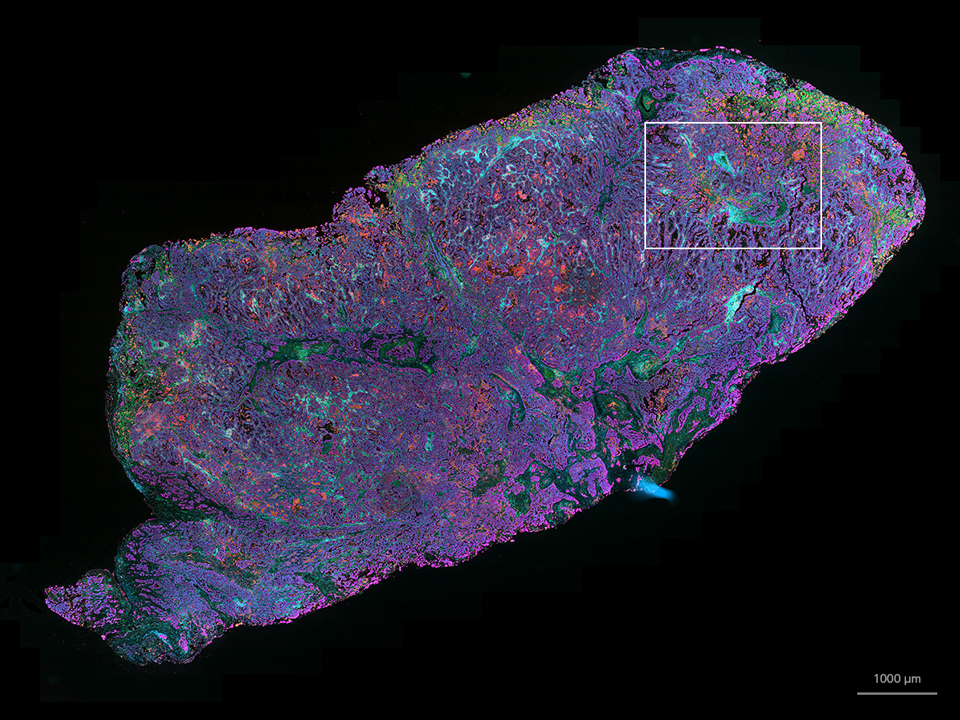 NSCLC tissue stained with UltiMapper I/O PD-L1 kit. Sample courtesy of Ultivue, Inc. Cambridge, Massachusetts, USA