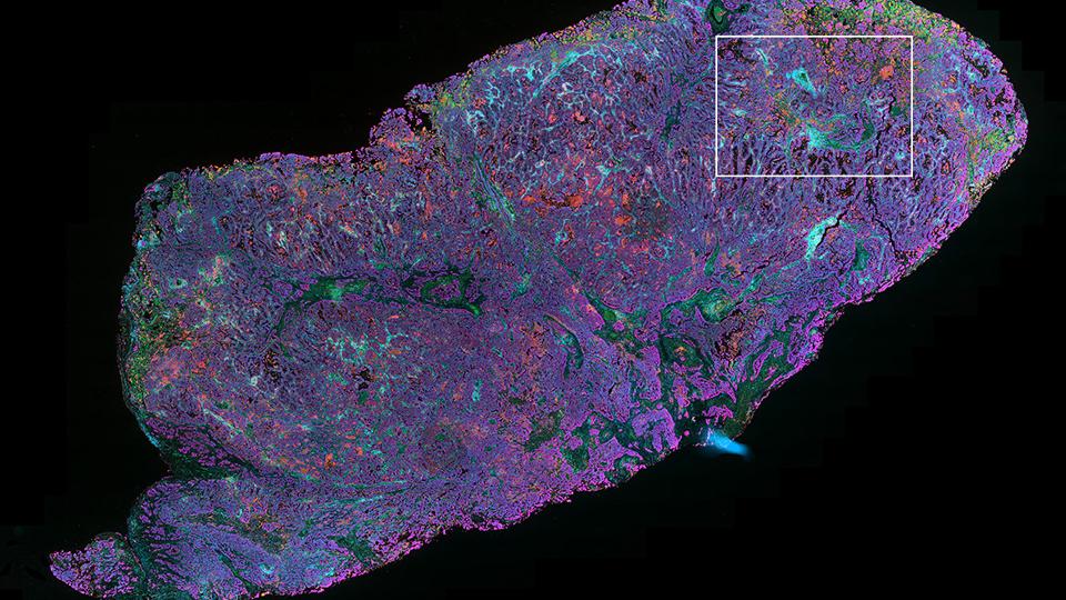 NSCLC tissue stained with UltiMapper I/O PD-L1 kit.